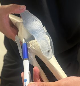 totale knie prothese - model knie gewricht